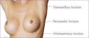 breast surgery procedure