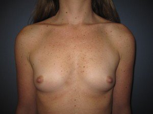 before breast augementation