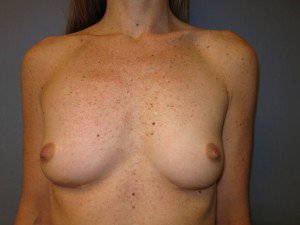 after removal of breast implants
