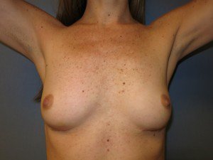 removal of breast implants