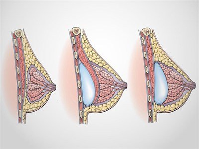 Scottsdale Breast Implant 