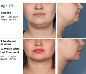 Double Chins Solution Kybella Procedure in Scottsdale